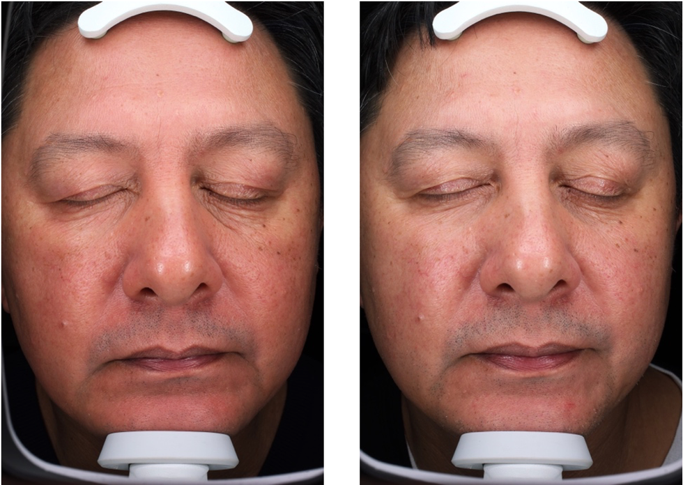 before and after images of a man using the visia complexion analyzer during the good housekeeping institute beauty lab's at home microcurrent device test