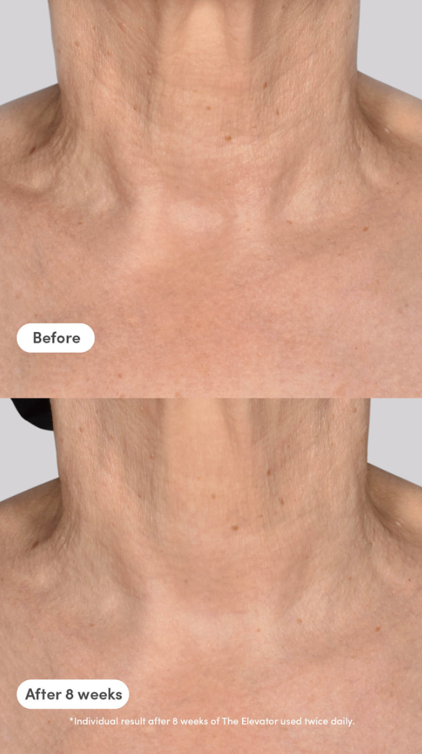 trinny woodall face lift surgery