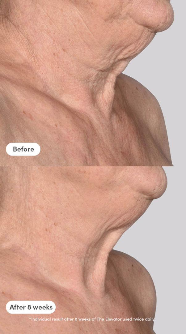 trinny woodall face lift surgery