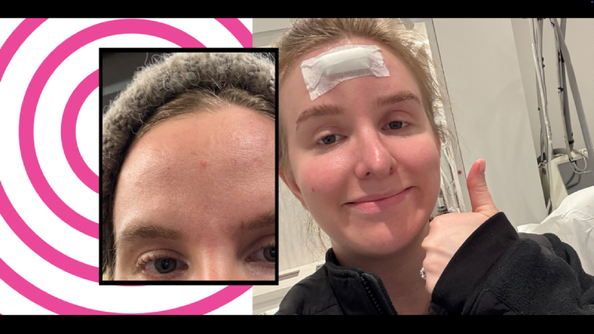 I Thought I Had A Zit On My Forehead—It Turned Out To Be Much More Serious