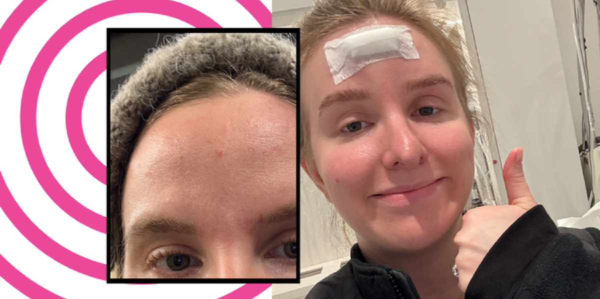 I Thought I Had A Zit On My Forehead—It Turned Out To Be Much More Serious