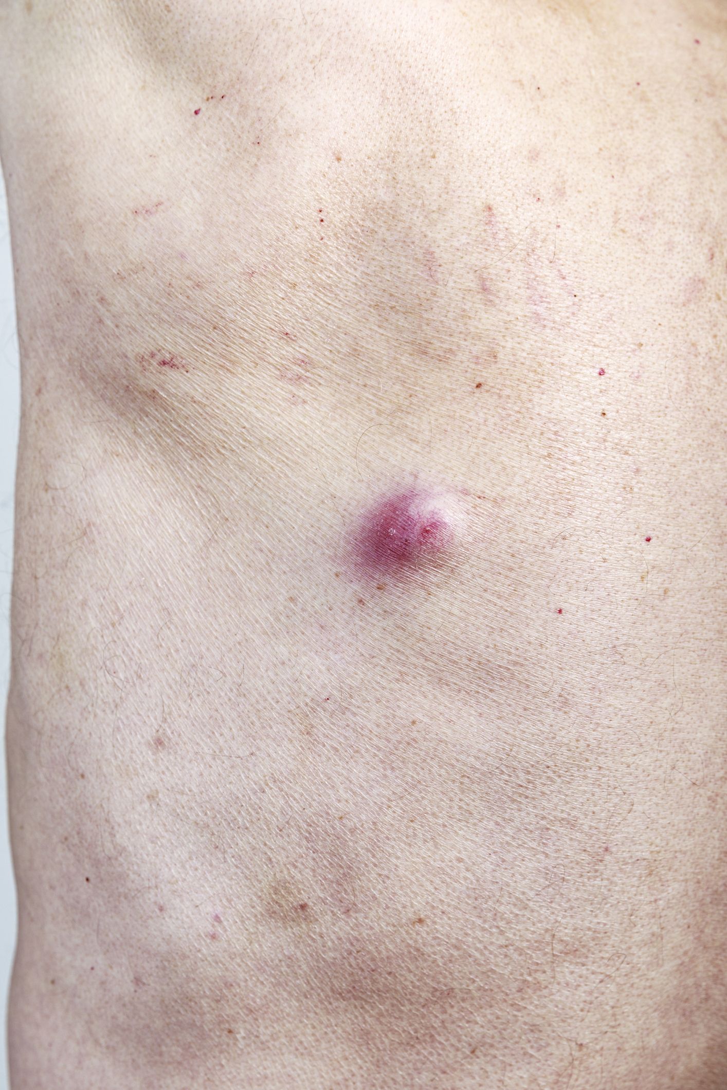 Pimple on stomach: Causes, treatment, and prevention