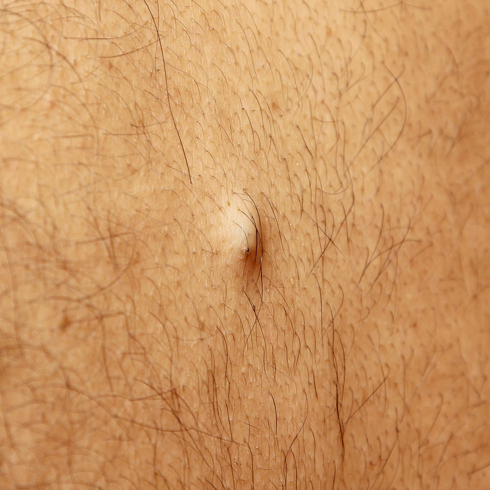 sebaceous cyst on the back of the male