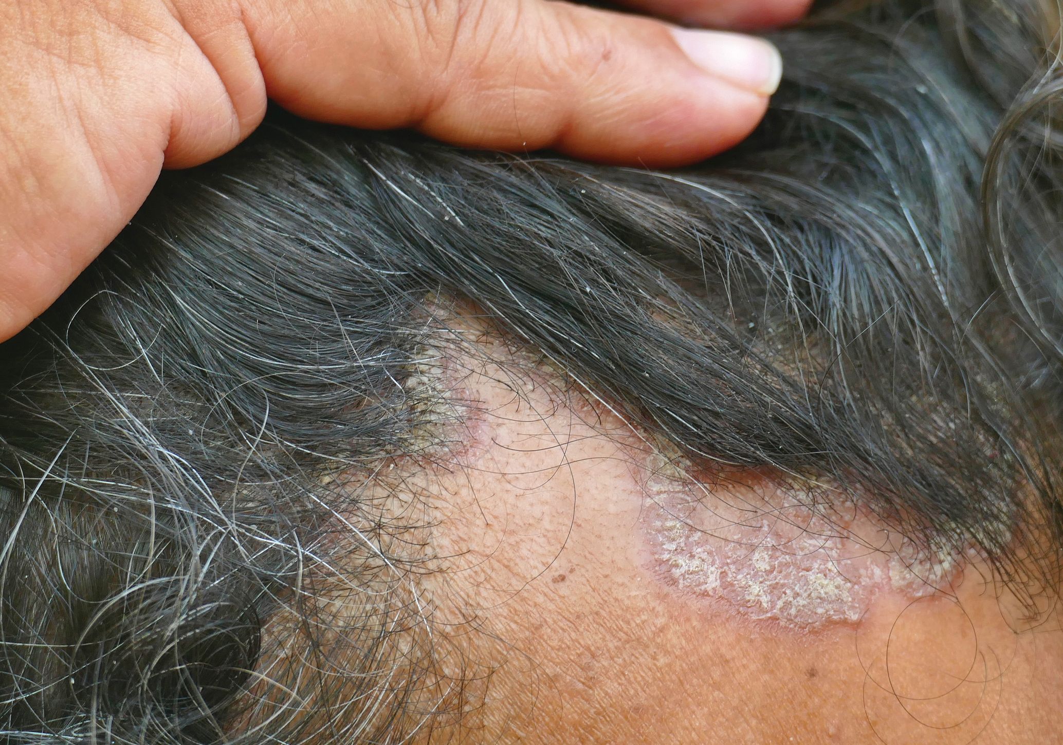 Symptoms and Causes of Persistant Scalp Itching  Atlanta GA