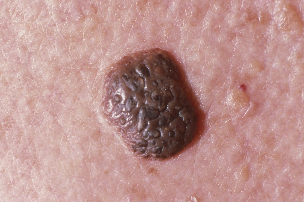 seborrheic keratosis