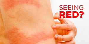 types of rashes