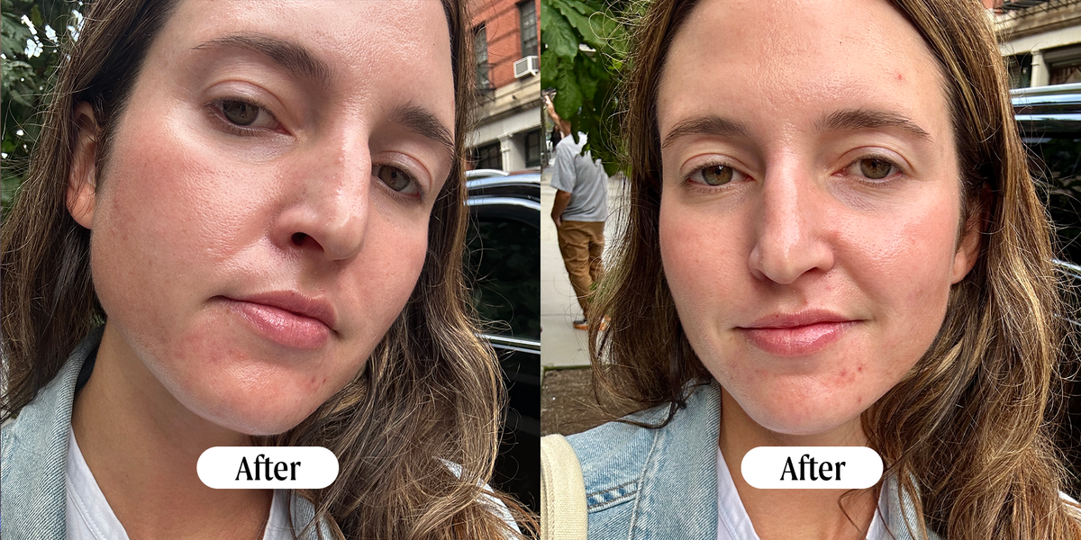 Are Hydrafacials Worth It: Unveiling the True Benefits