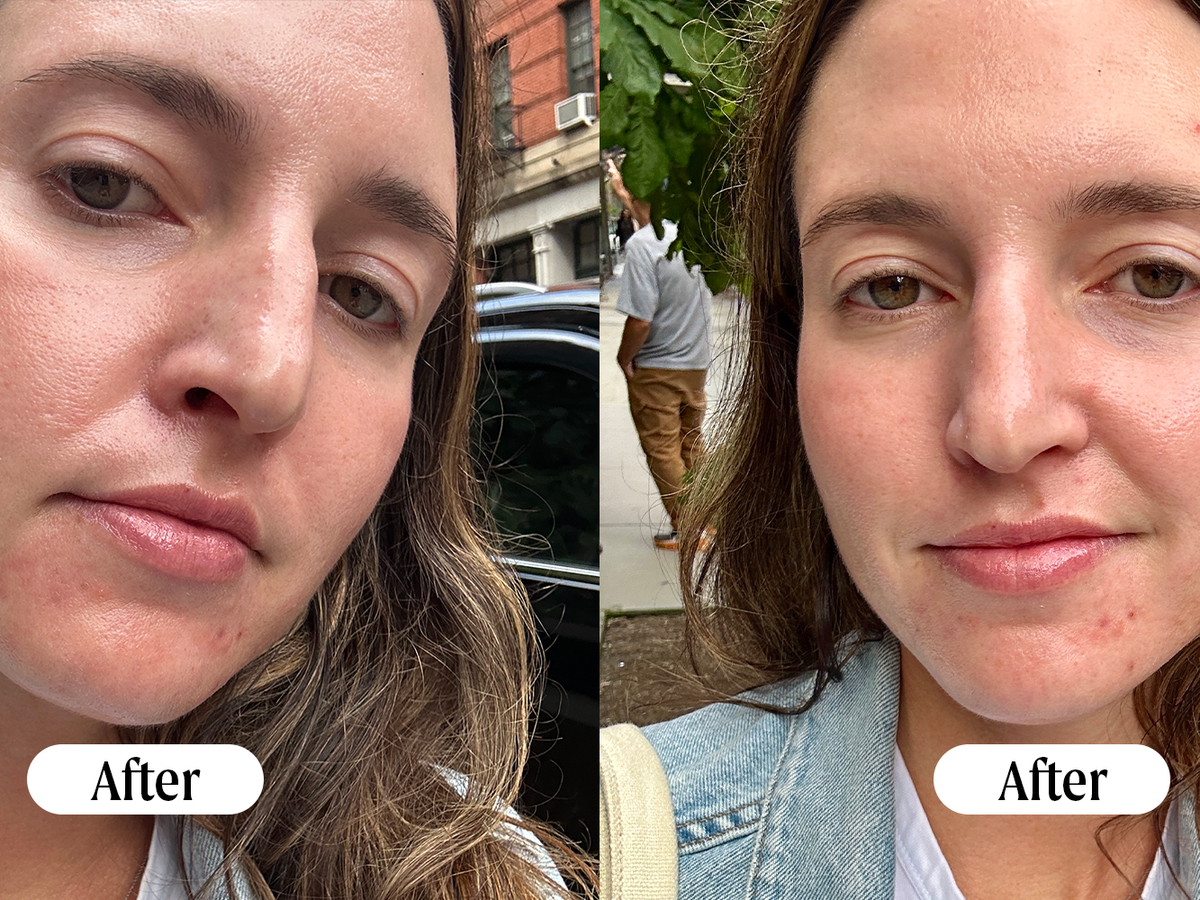 Are Hydrafacials Worth It: Unveiling the True Benefits