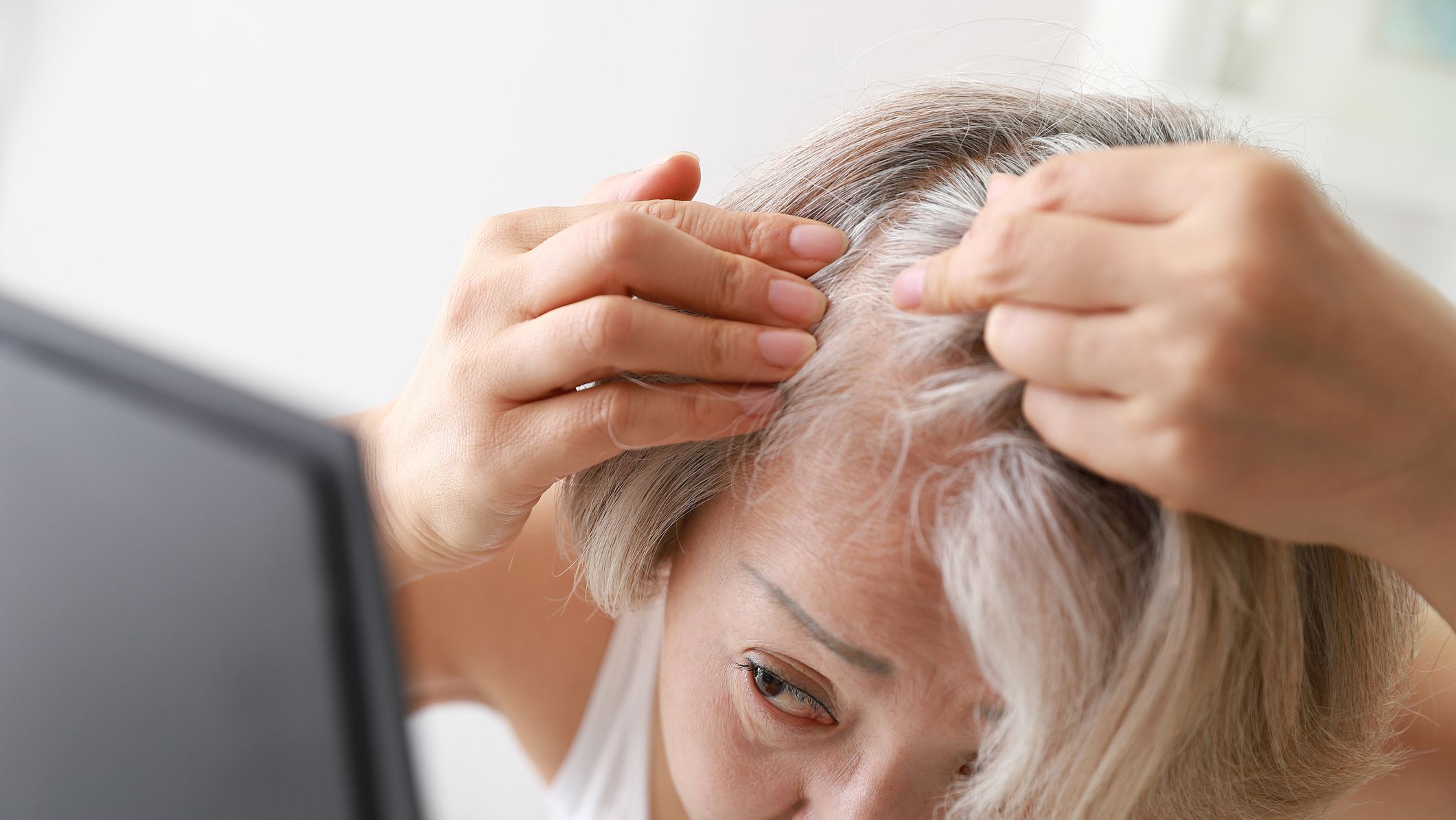 Nourish Your Scalp: Nutritious Food for Dandruff Or Sores