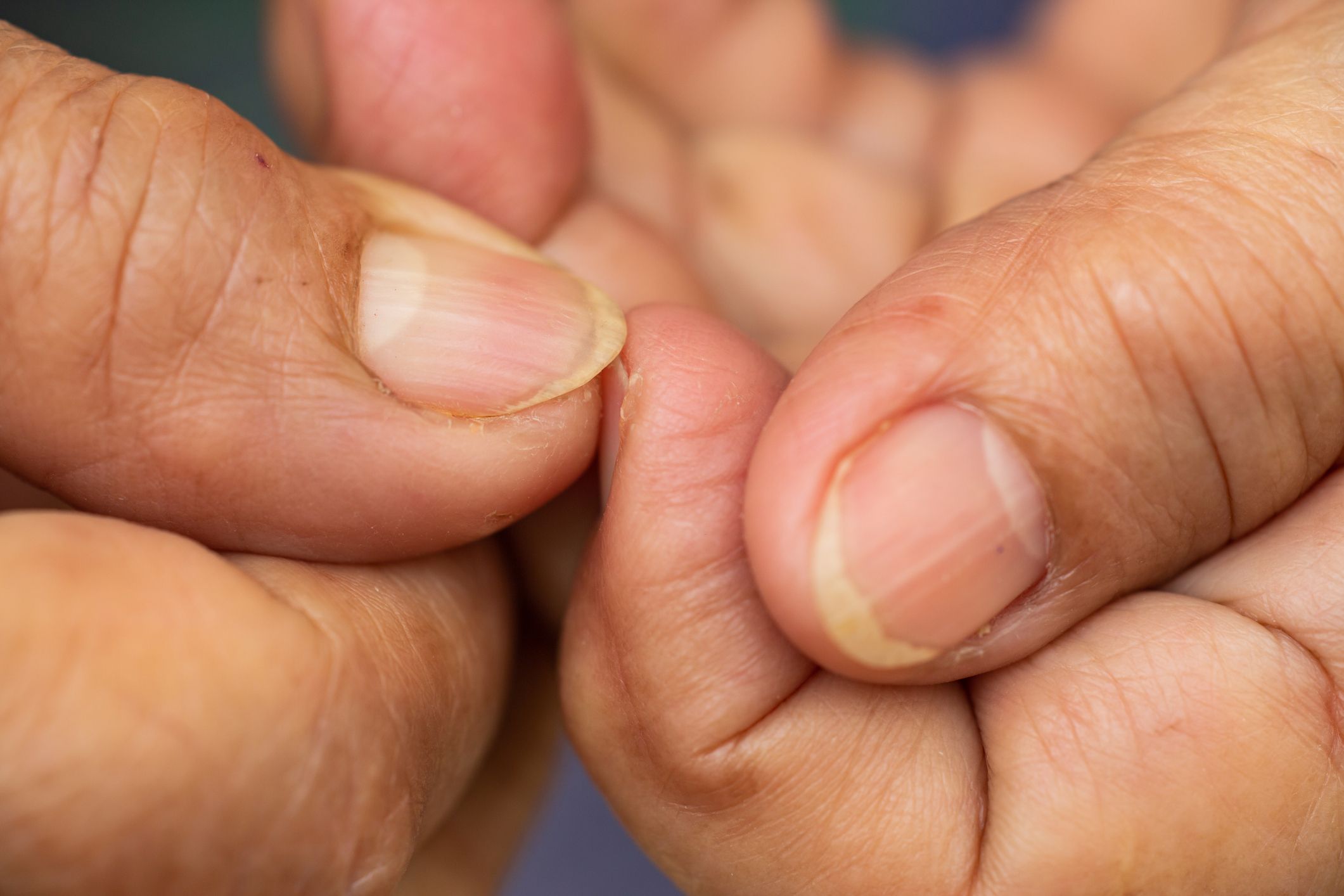 From arthritis to anaemia... what your fingernails could tell you about  your health | The Sun