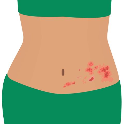 shingles on a woman body   varicella zoster   vector illustration