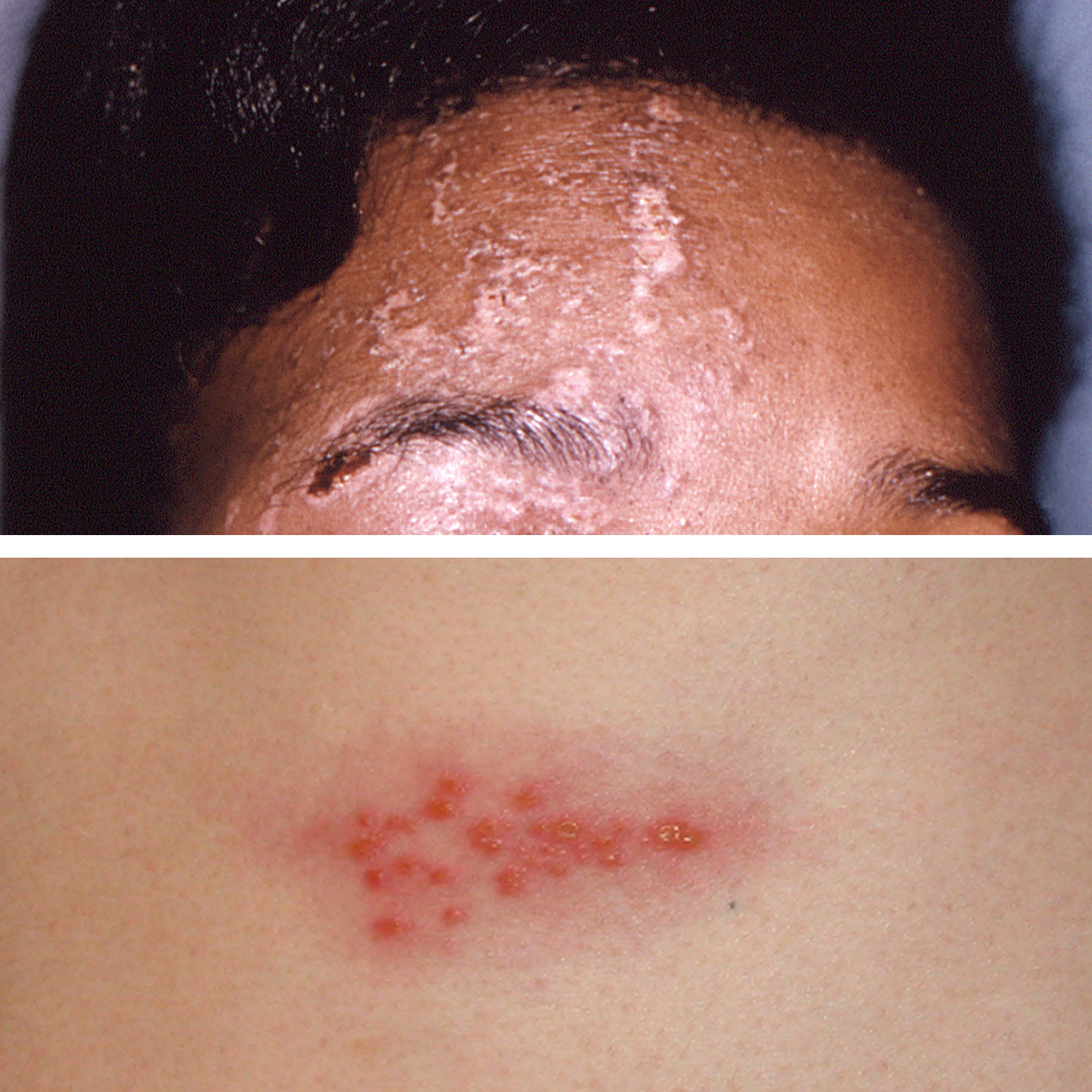 Adolescent female with rash on the arms and posterior legs