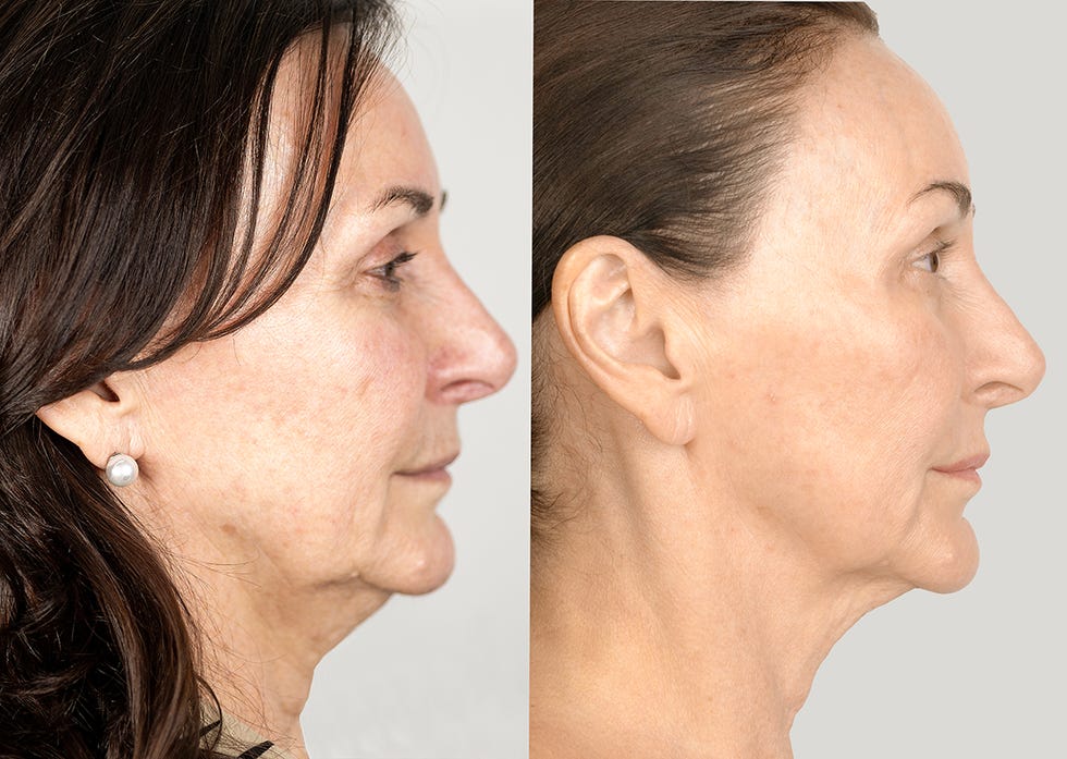 shirley ballas cancels facelift after having neogen skin treatment