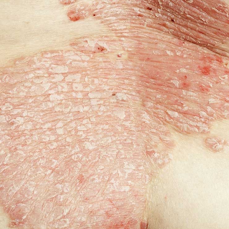 serious health issues associated with psoriasis