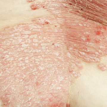 serious health issues associated with psoriasis