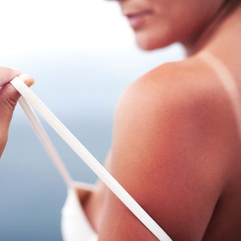 Sunburn tan line on shoulder