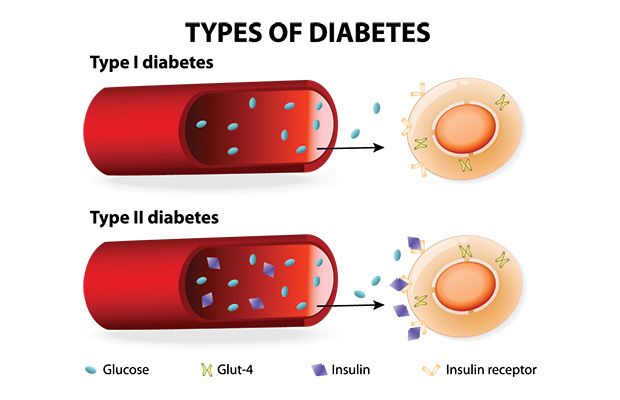 Type 1 vs type 2 diabetes