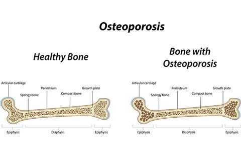 Osteoporosis risk increase