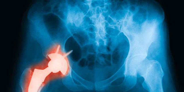 4 Ways To Make Sure You Never Have To Get A Hip Replacement