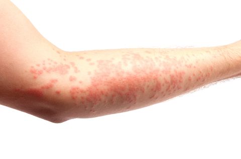 skin allergy hives
