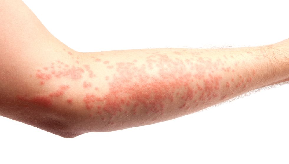 skin allergy
