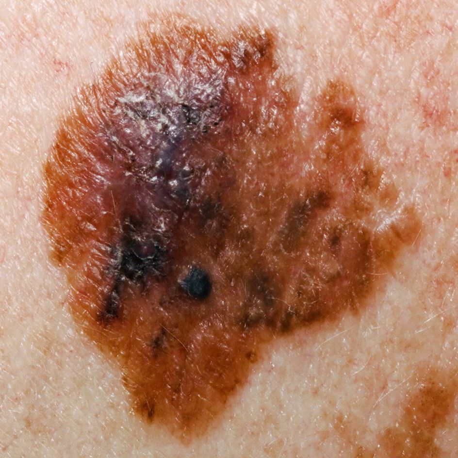 a mole on skin with uneven shape and edges