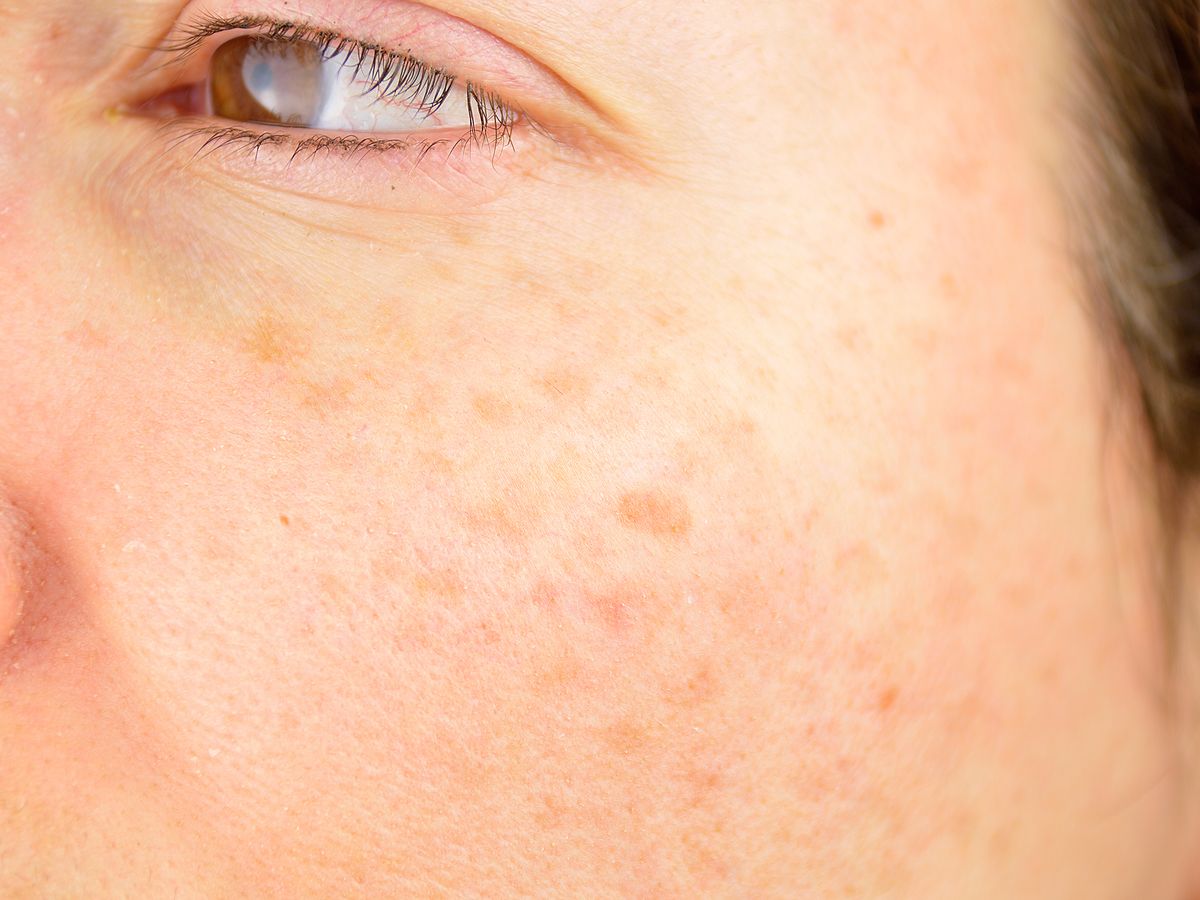 Sunspots on Face: Causes, Treatments, Prevention and Skin Cancer