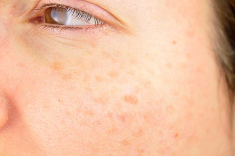 7 Best Ways To Get Rid Of Age Spots Top Removers For Dark Spots