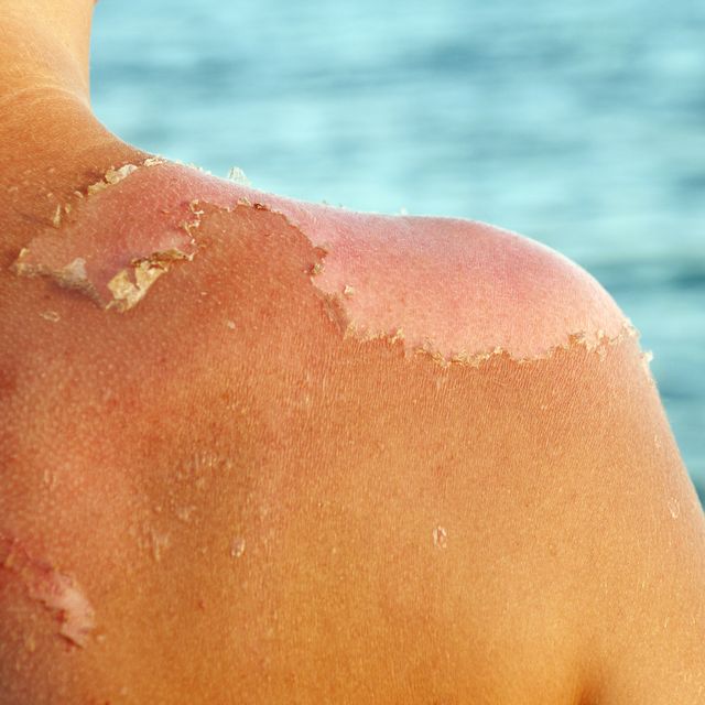 how to treat a sunburn, how to prevent sunburn, best sunscreens, best spf