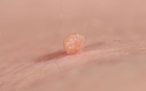Pedunculated skin tag or acrochondon or soft fibroma. Papilloma bump on male body macro shot. Fibroepithelial polyp on stalk. Benign epidermis lesion close up.