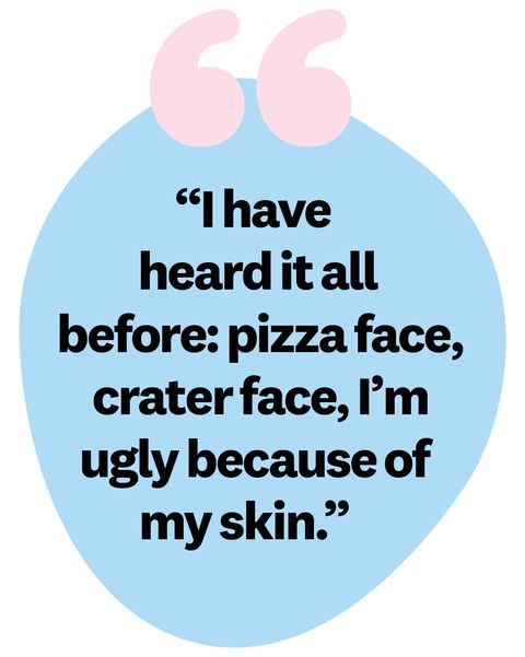 i have heart it all before pizza face, crater face, i'm ugly because of my skin"