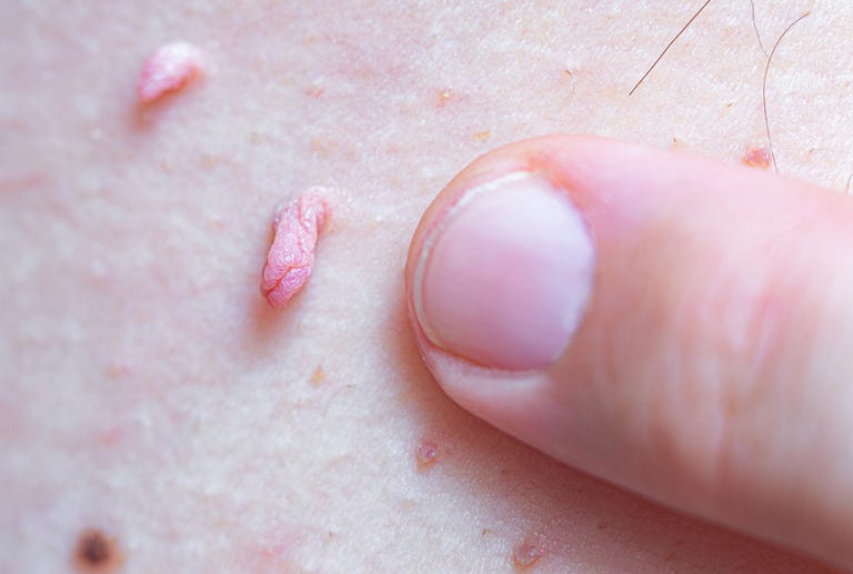 Skin Tag Removal: Can You Remove Skin Tags Yourself at Home?