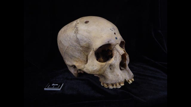 schedel met tumor en uitzaaiingen uit het oude egypte