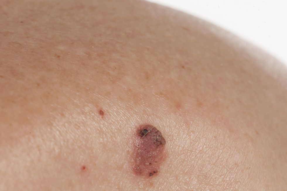 basal squamous cell carcinoma