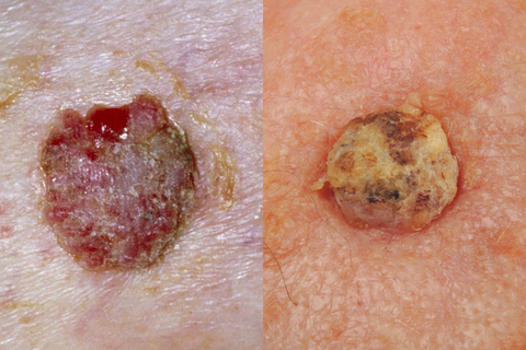 squamous cell carcinoma skin cancer pictures