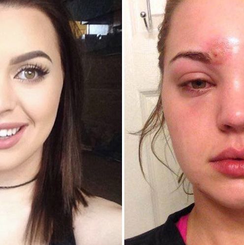 Girl Staph Infection From Not Washing Her Makeup Brushes