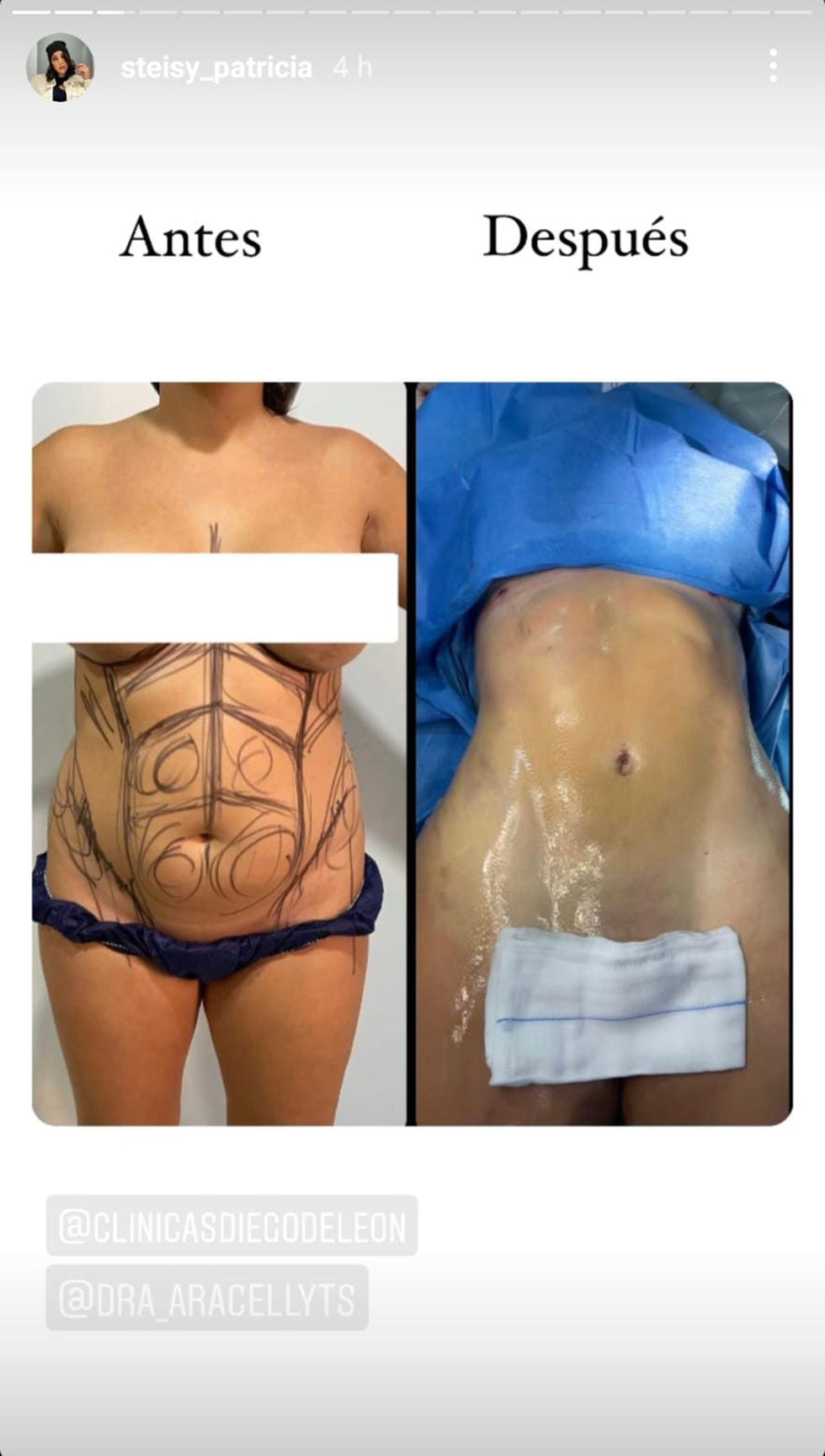 steisy cuenta el motivo de su liposucción y muestra el resultado de su pérdida de peso