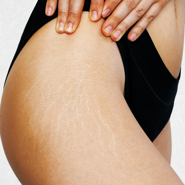 16 Best Stretch Mark Creams of 2024 (Tested and Reviewed)