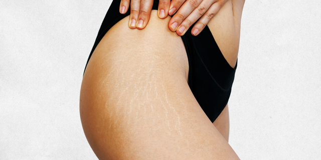 9 Natural Stretch Mark Treatments Backed by Science