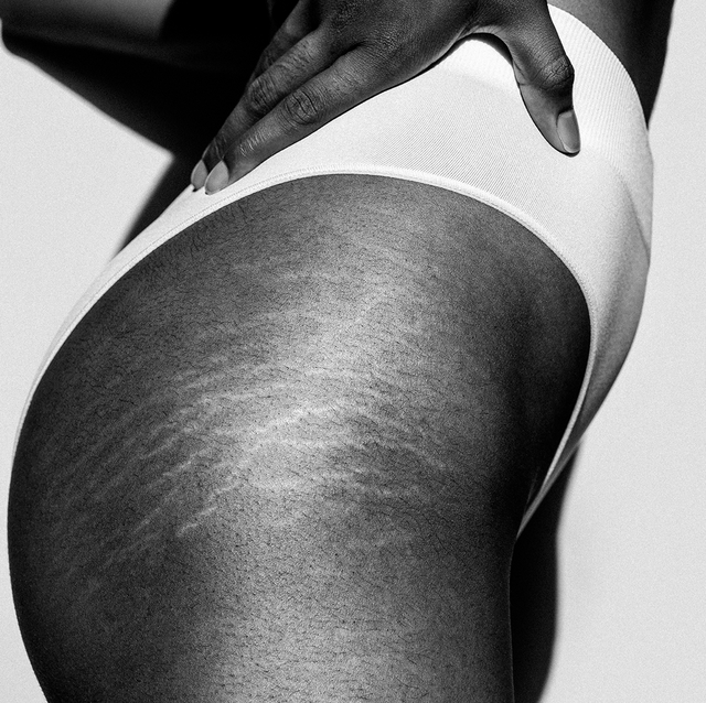 Stretch Marks in Teen Boys: Are They Normal?