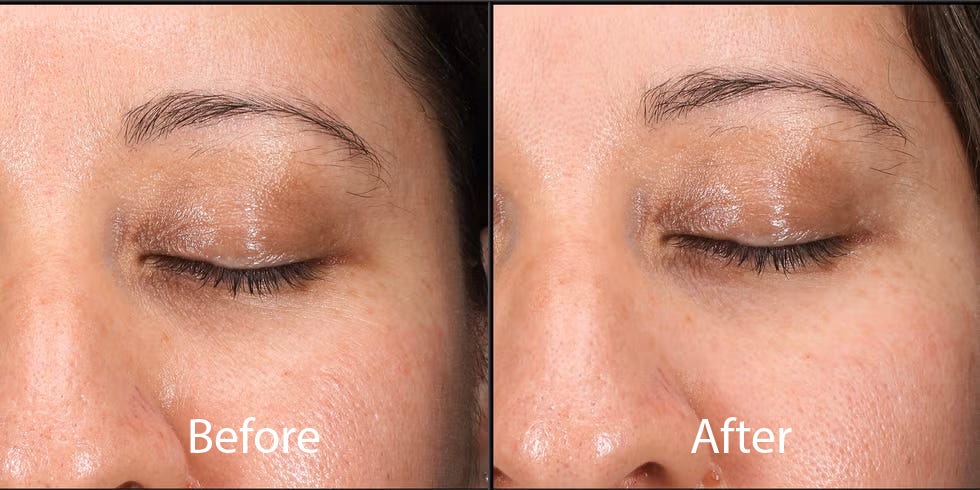 9 best wrinkle fillers to temporarily smooth fine lines