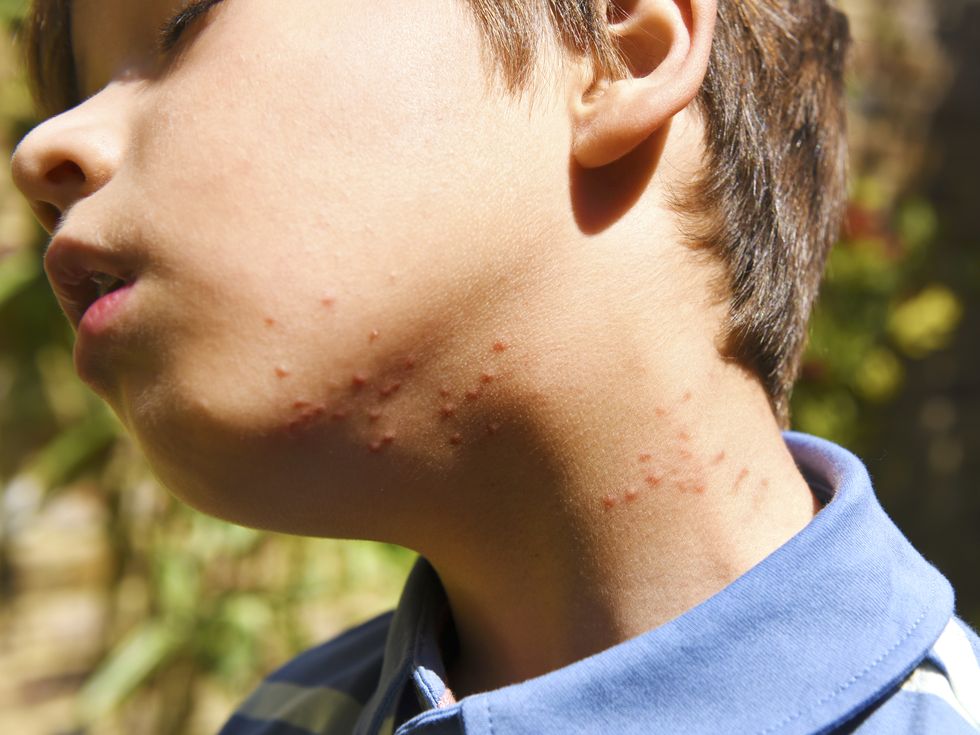 summer insect bites on boys neck