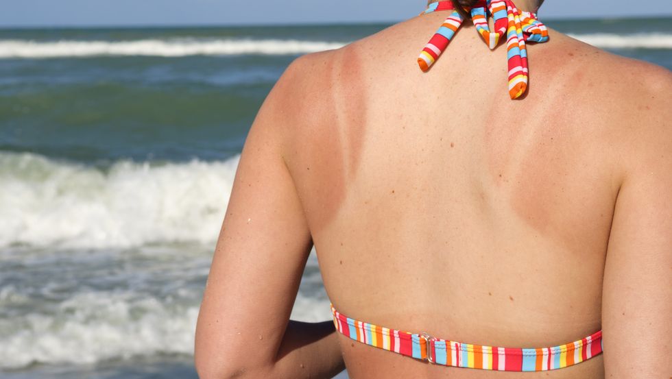sunburn woman at beach