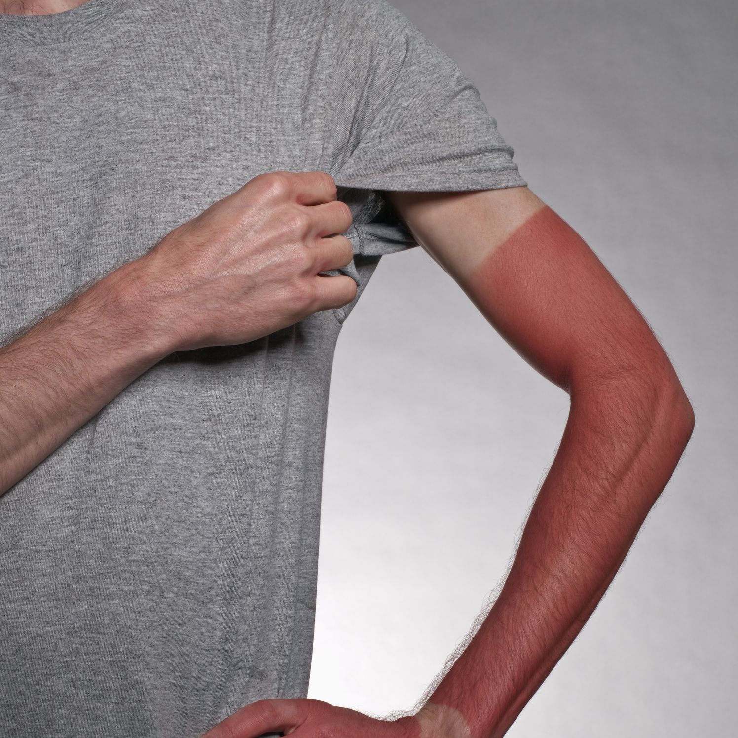 5 Tricks for Getting Rid of That Painful Sunburn