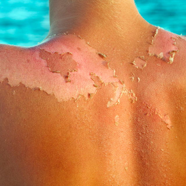 sunburn peeling skin