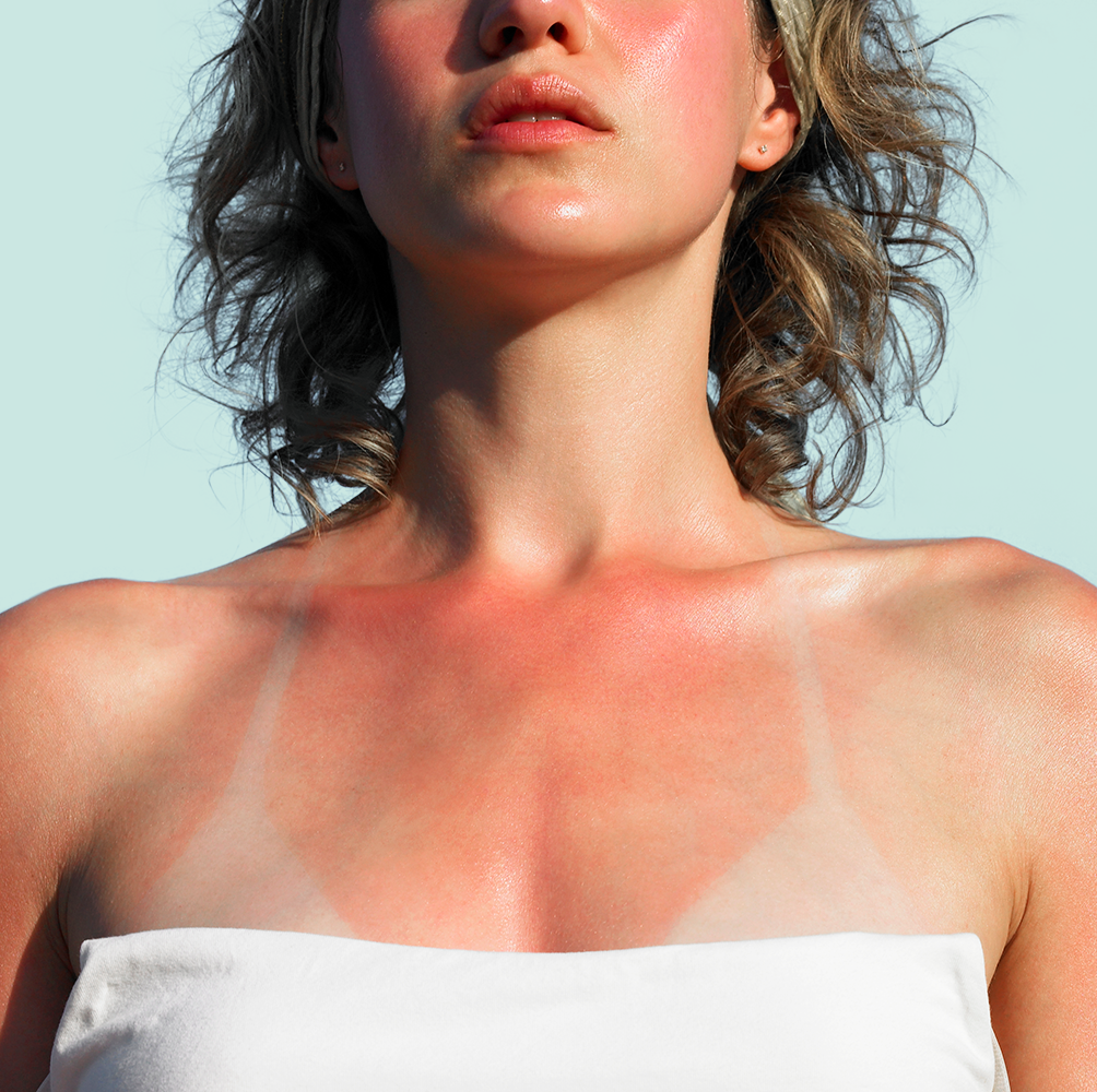 How do I wear a bra with sunburn?