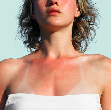 woman on a blue background with a sunburnt chest