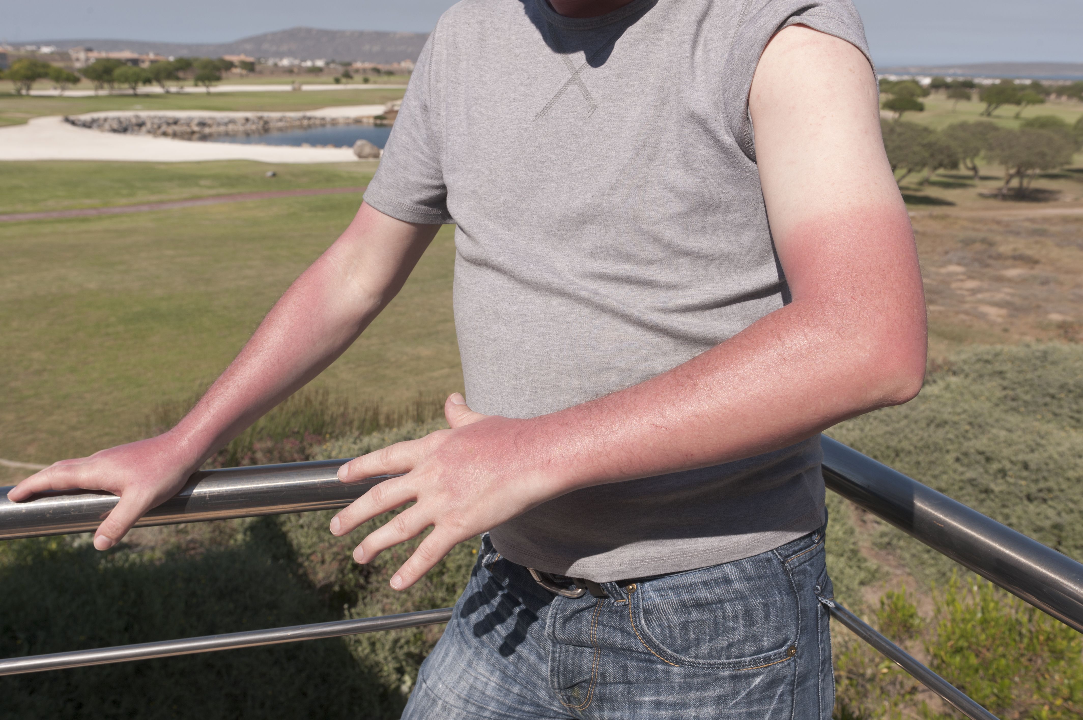 The Stages of a Sunburn | How a Sunburn Affects Your Skin