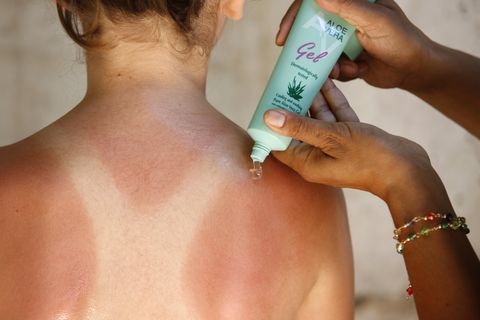 how to treat a sunburn, how to prevent sunburn, best sunscreens, best spf