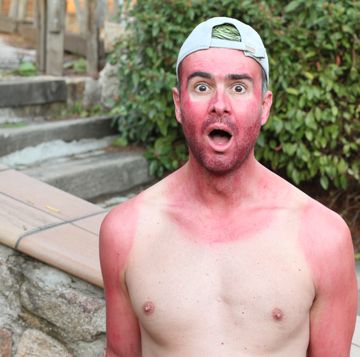 sunburned young man with extreme tan lines